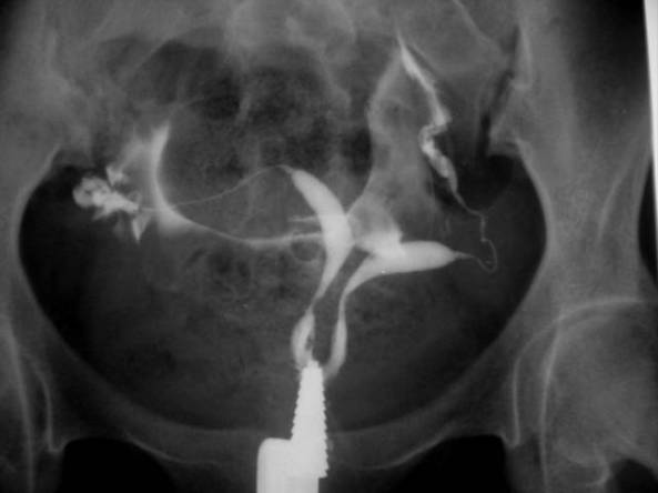 HYSTEROSALPINGOGRAM